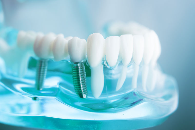 dental implants model