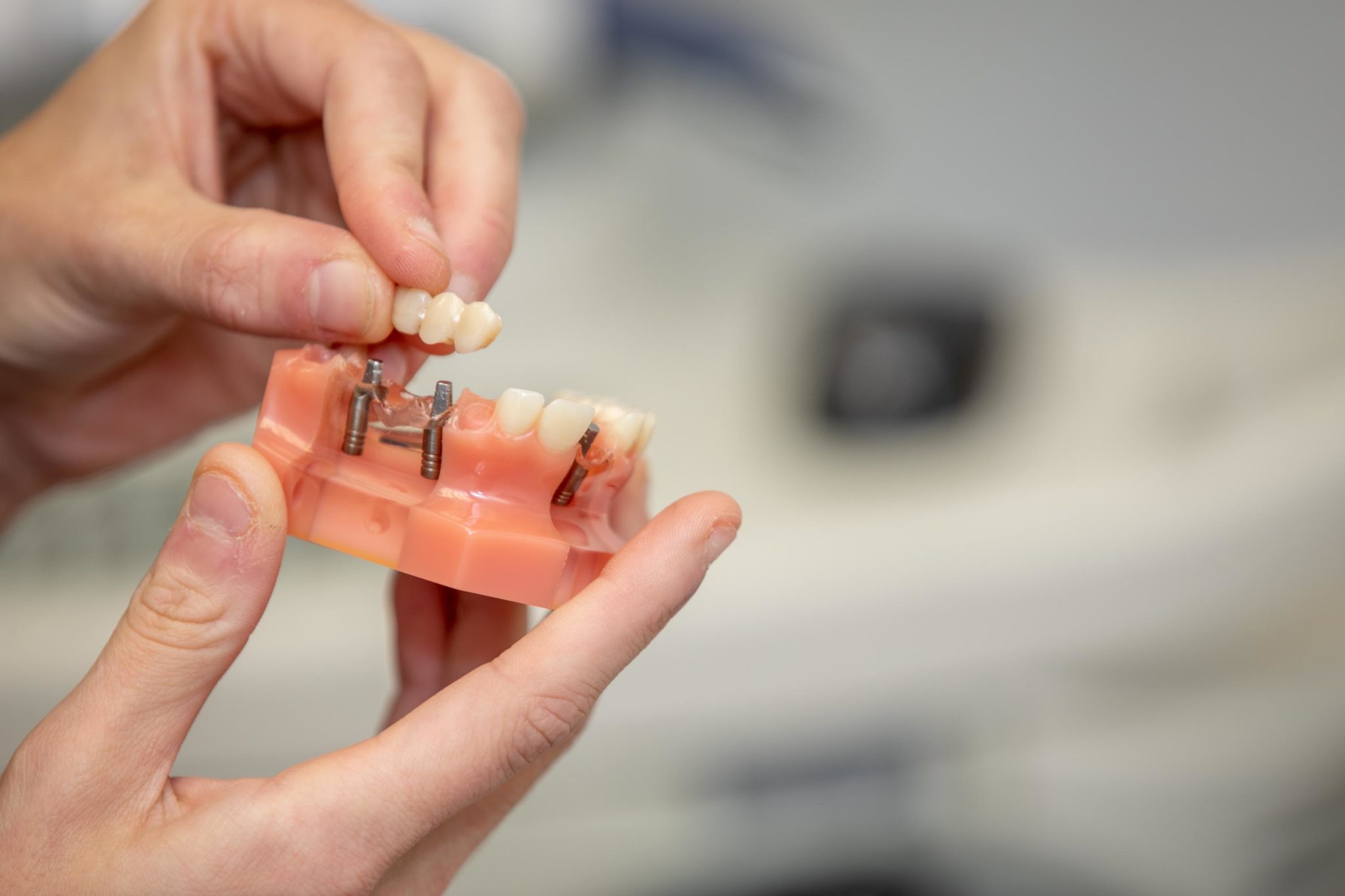 Dental Implants in Bowmanville West Bowmanville Dental