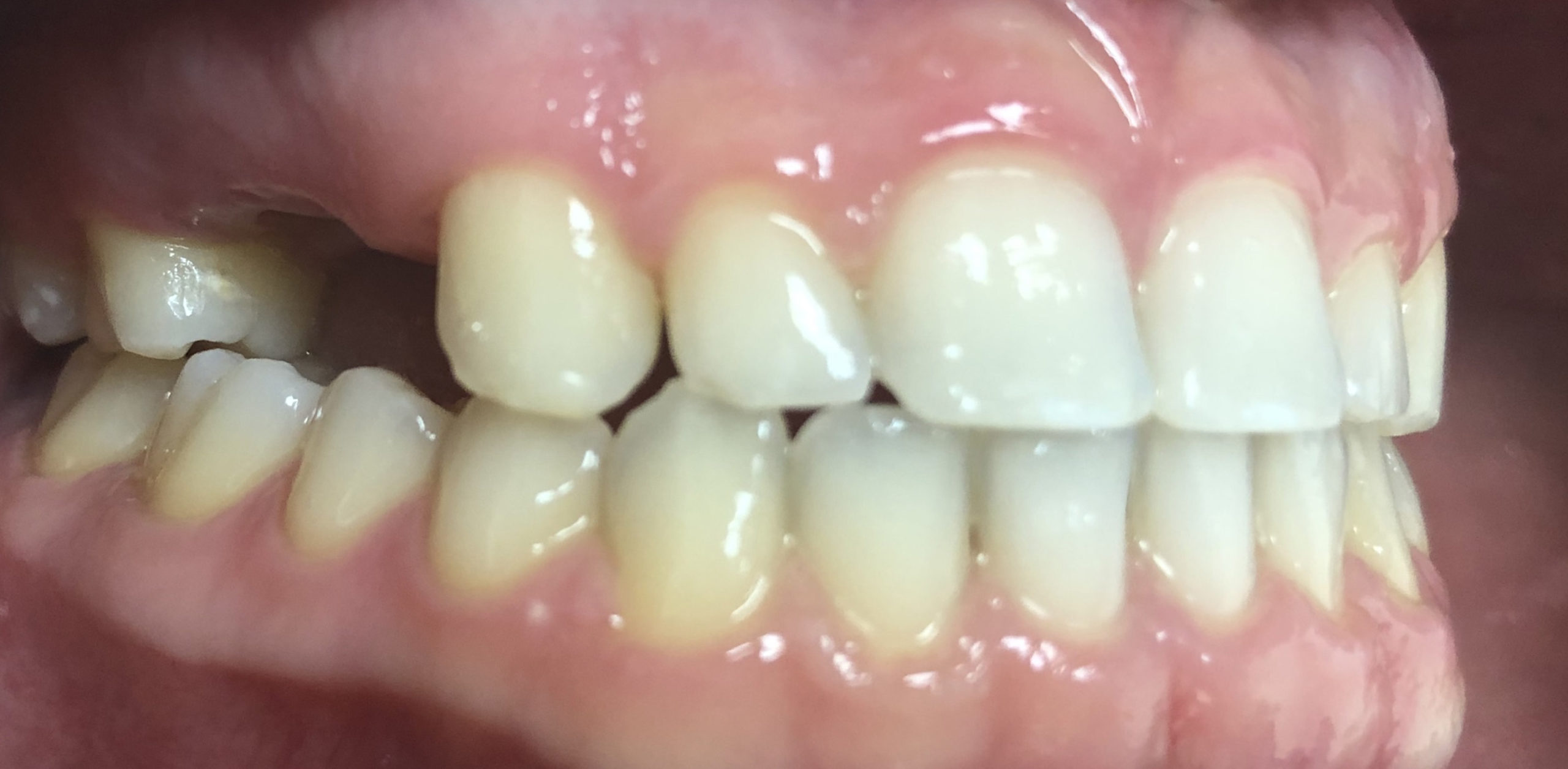 Before & After Results West Bowmanville Family Dental