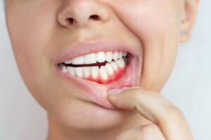 Close-up of inflamed gums showing signs of gingivitis or early gum disease—highlighting the importance of periodontal care and oral hygiene.