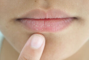 Patient with Cracked Lips