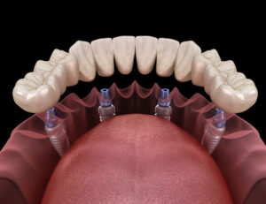 Full arch fixed dental prostheses on dental implant with black background. Zircon bridge on 4 dental implants