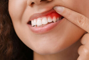 Gum disease