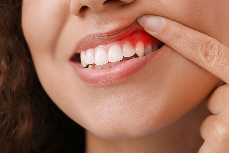 Gum disease